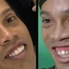 بالفيديو والصور .. إبتسامة رونالدينيو هوليوودية بعد تعديل "أسنانه"