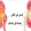 صور/ طرق الوقاية من حصوات الكلى