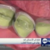 فقدان الأسنان قد يؤثر في صحة القلب فقدان الأسنان قد يؤثر في صحة القلب