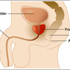 البروستاتا تسبّب اضطرابا جنسيا -